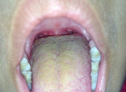Hand foot and mouth disease vagina White wife sex tube